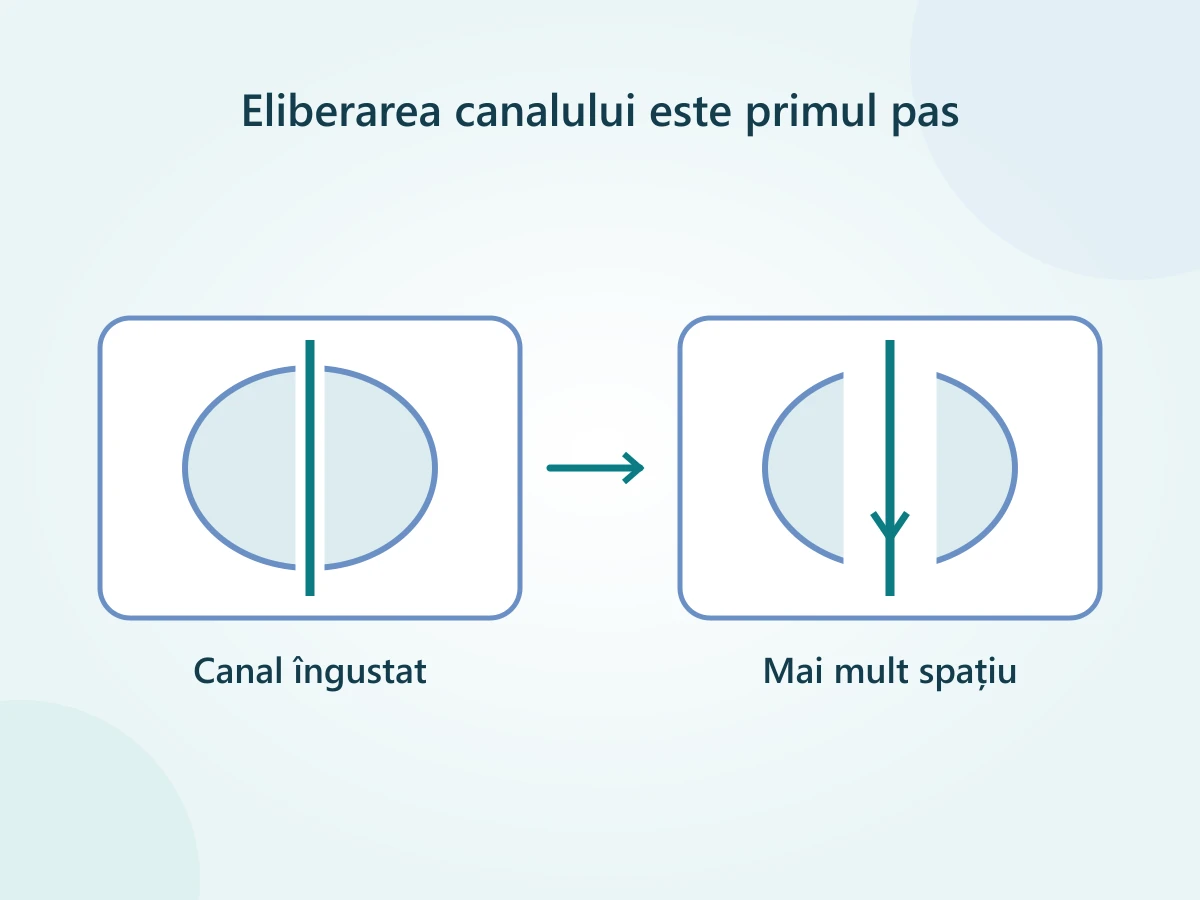 Schemă simplificată: canalul urinar îngustat de țesutul prostatic și spațiul mai larg rămas după îndepărtarea țesutului obstructiv.